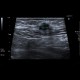 Suture granuloma, Schloffer's tumor: US - Ultrasound